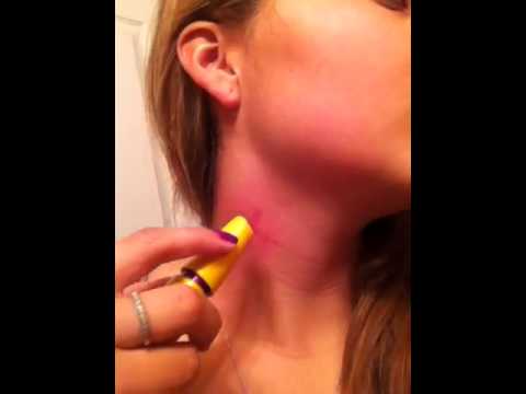 how to cure hickey through pen cap