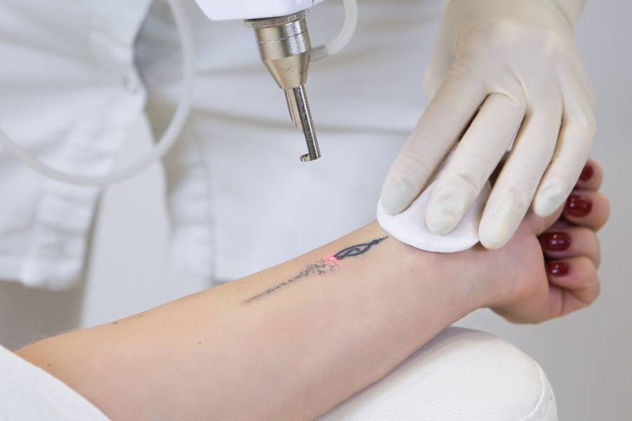 Tattoo-removal-specialist austin texas