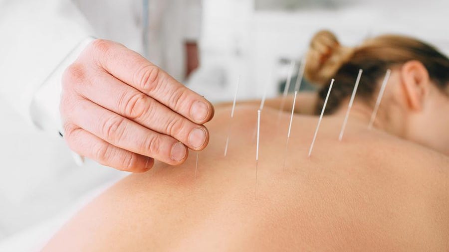 Acupuncture for natural pain relief