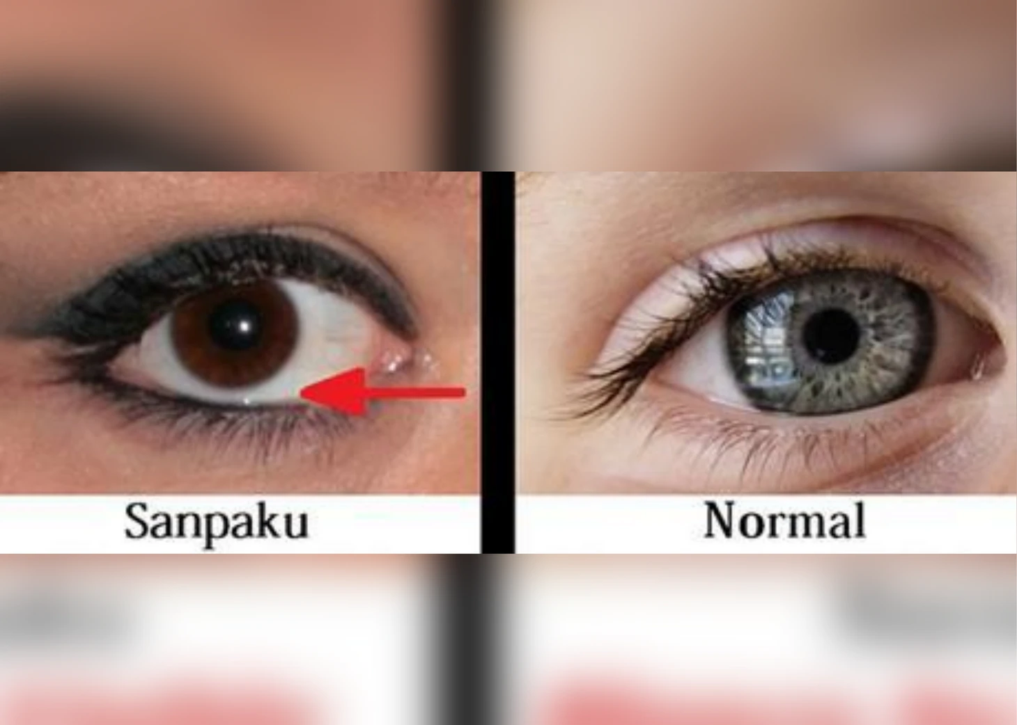 sanpaku-eyes-normal eyes difference